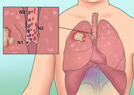 Уушги өвчилснийг хэрхэн мэдэх вэ?